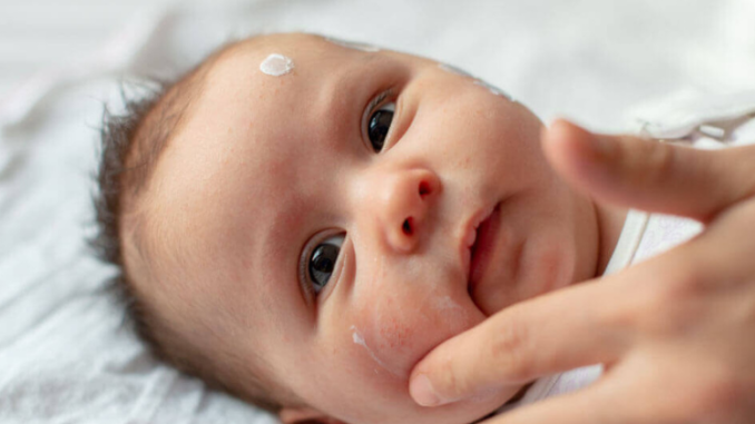 Eczema-chez-votre-nourrisson-que faire