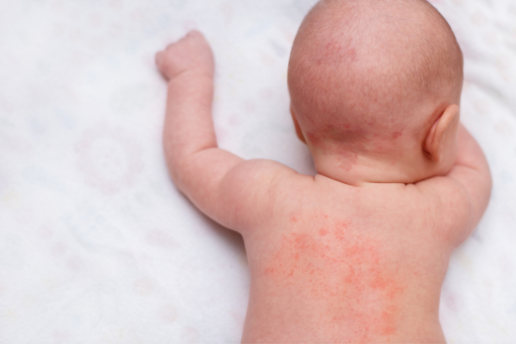 Eczema-chez-votre-nourrisson-les causes
